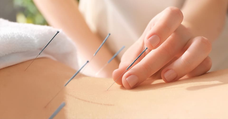 acupuntura